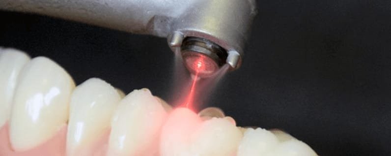 Painless LASER DENTISTRY